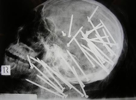 nails-x-ray-pic-getty-image-1-49912.jpg